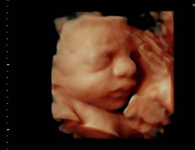 3D ultrasound image at 31 weeks